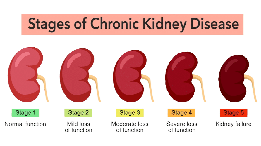 Risk of Dialysis