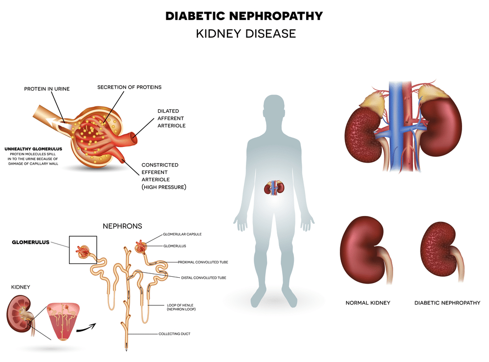 Diabetes Related Complications