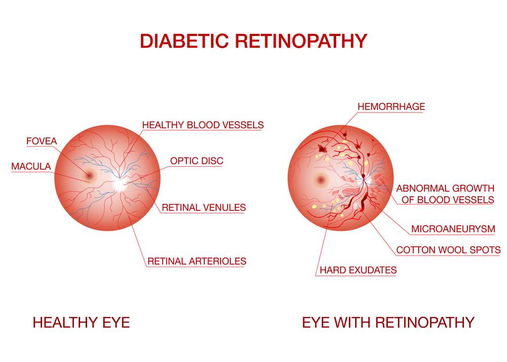 Risk of Diabetes Related Complications